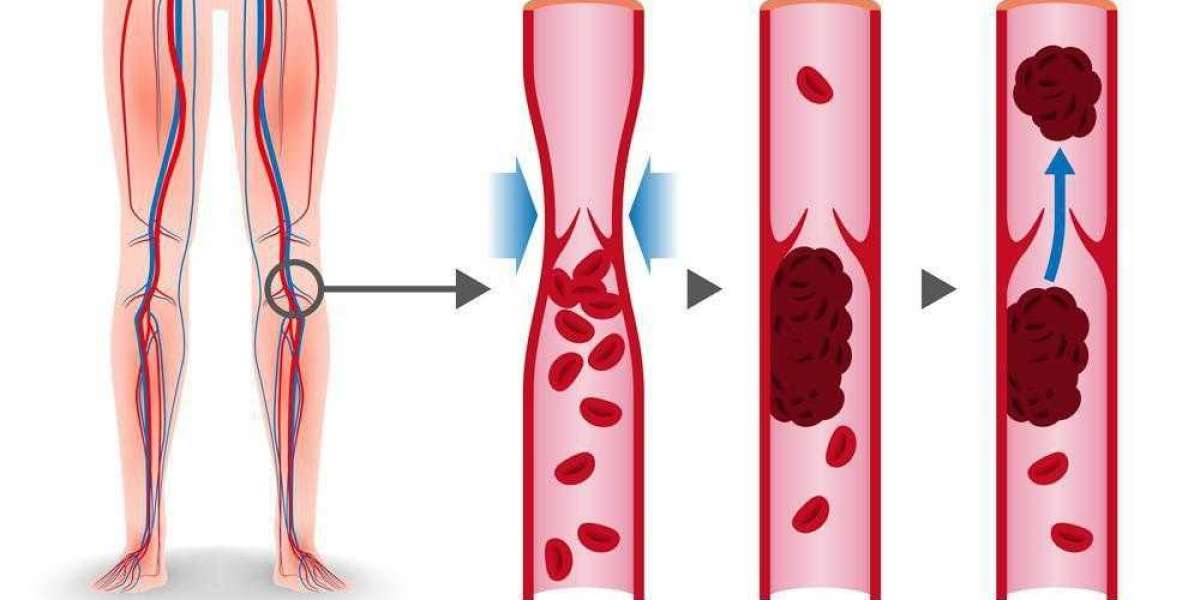 DVT Symptoms Explained: Causes, Signs, and Prevention Tips