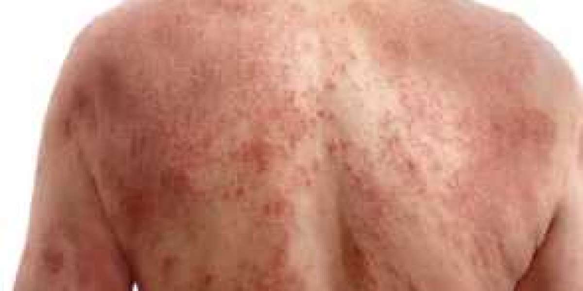 The Role of Ivermectin 3mg in Preventing and Managing Parasitic Diseases