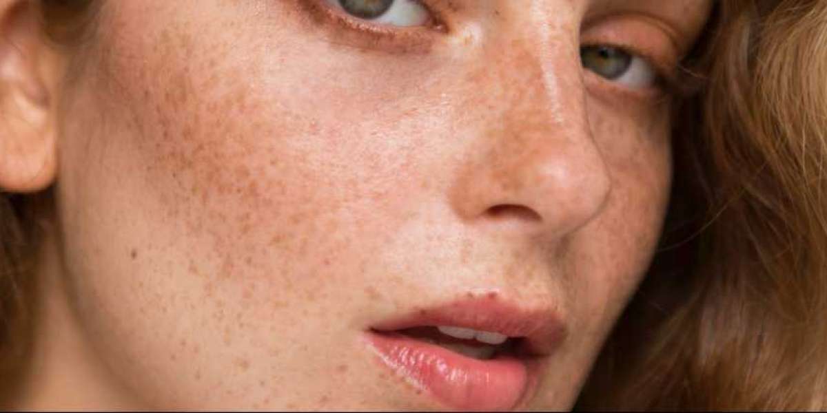 pigmentation laser removal singapore