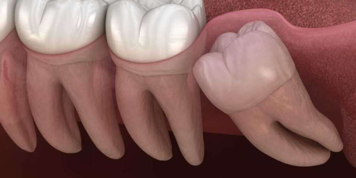 affordable wisdom teeth removal